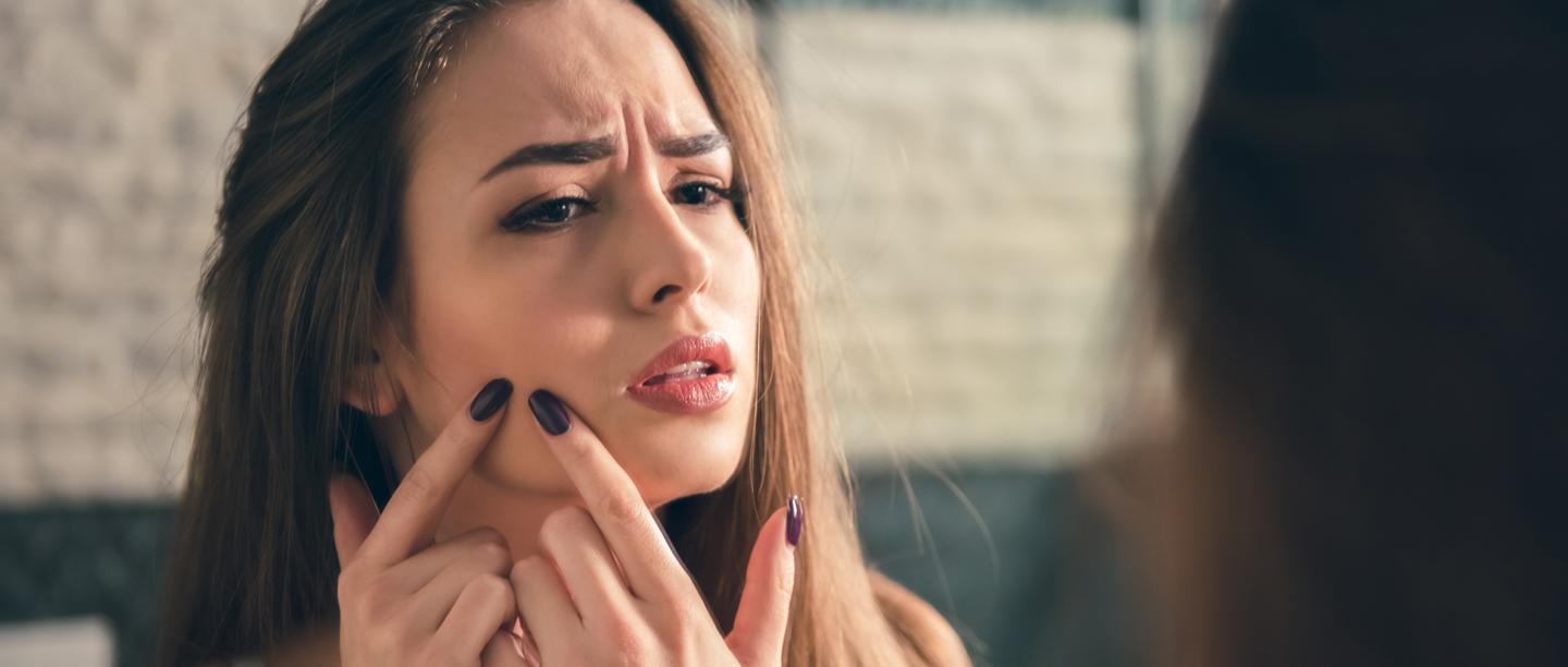 మొటిమలు నుండి తక్కువ సమయం లో  సంపూర్ణ విముక్తి పొందండి  (How To Remove Pimples In Telugu)